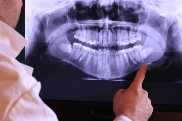 Best Emergency Treatment for Dental Infections or Abscesses in Lafayette, IN